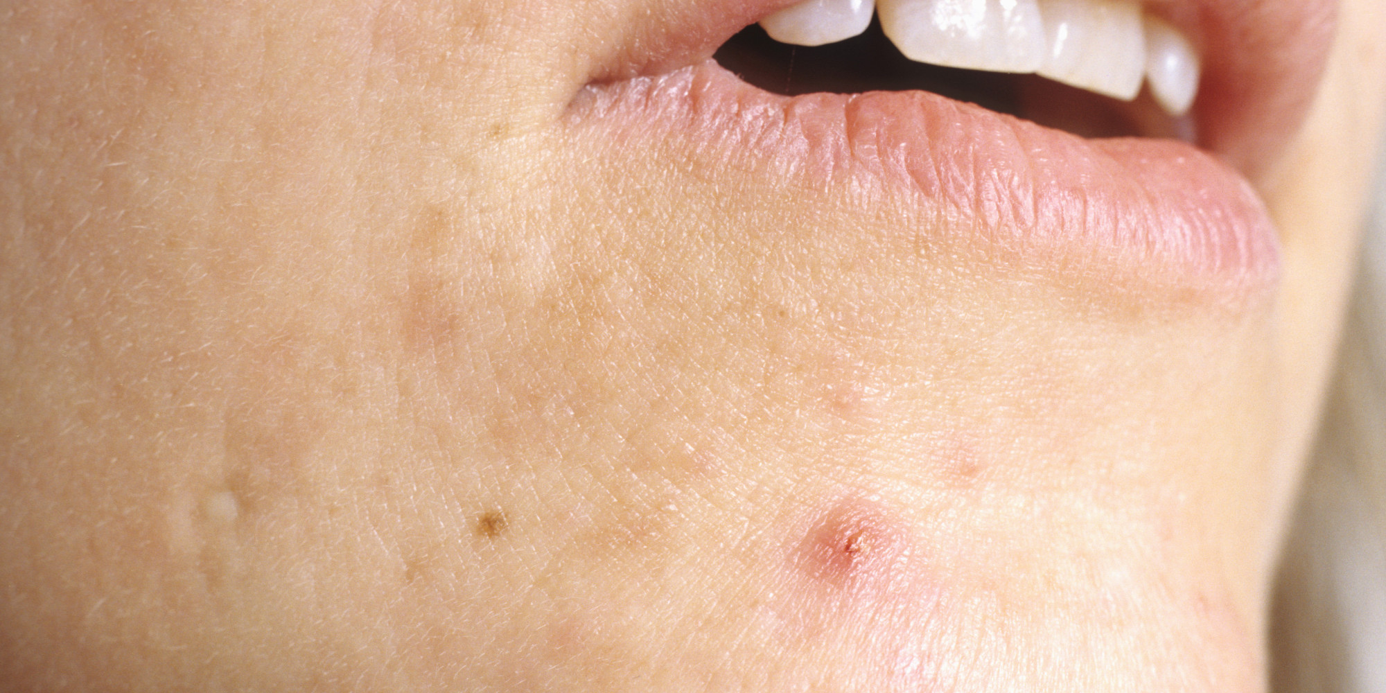 Everything You Ever Wanted To Know About Cystic Acne 