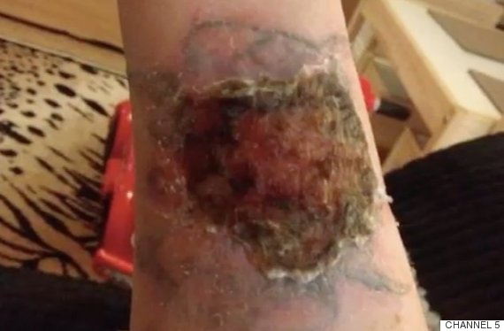 Tattoo Removal: Woman Pours Pure Acid On Arm In Attempt To Remove Ex ...