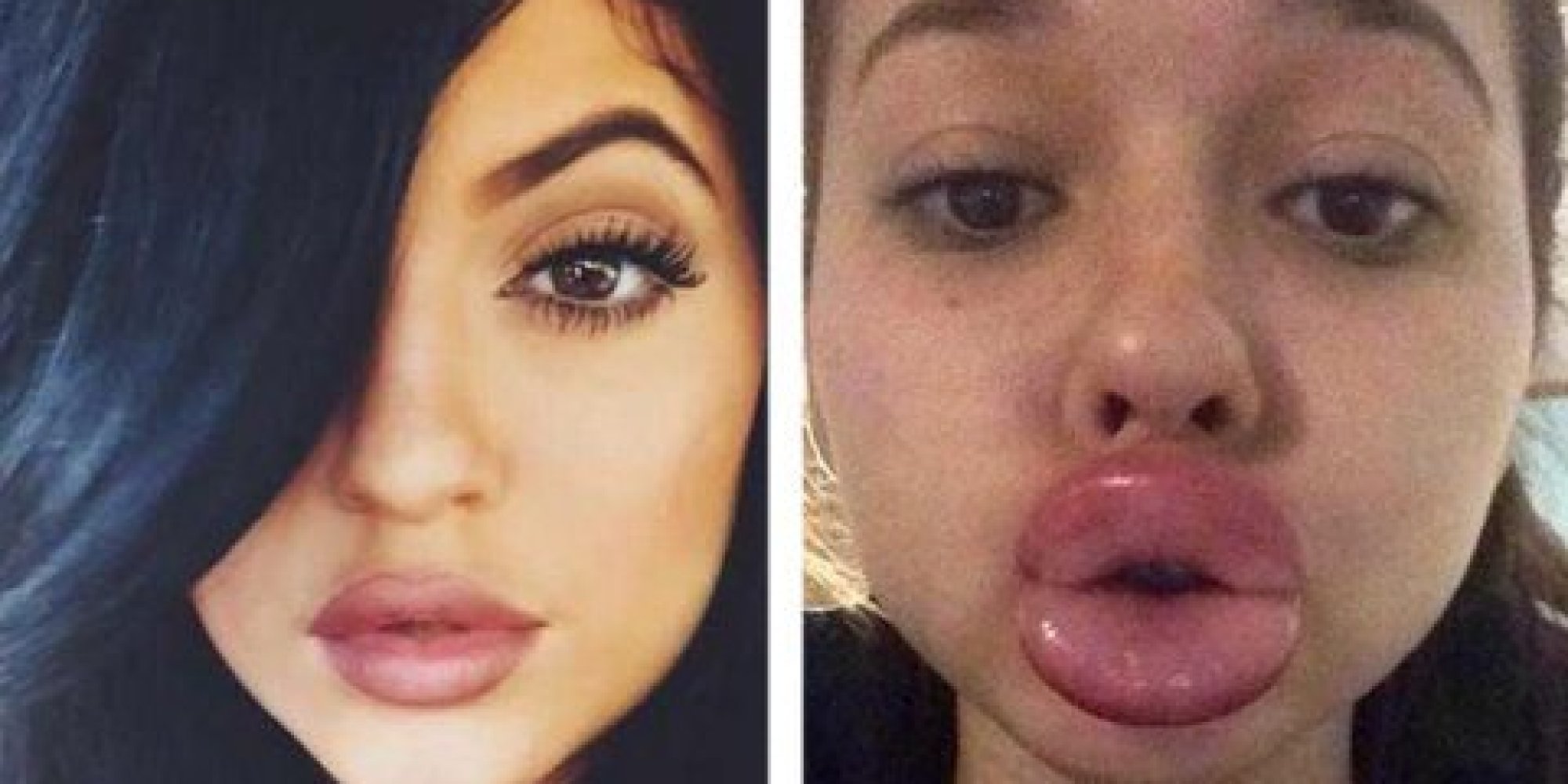 Le Kylie Jenner Challenge Ou Pourquoi Les Ados Se Gonflent Les Lèvres 
