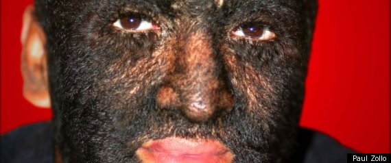 werewolf syndrome. Cure #39;Werewolf Syndrome#39;