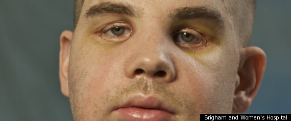 Face Transplant