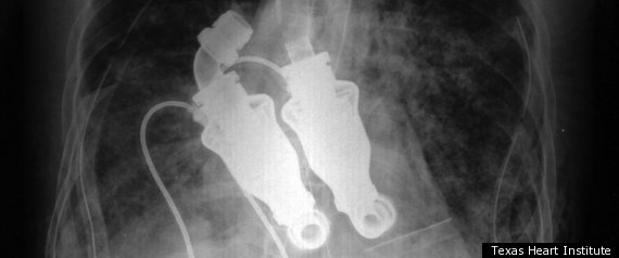 Pulseless Heart