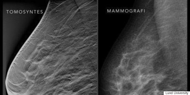 This Screening Method Is Way Better At Spotting Breast Cancer