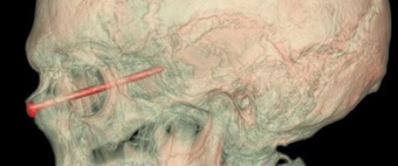 NAIL STUCK IN EYE