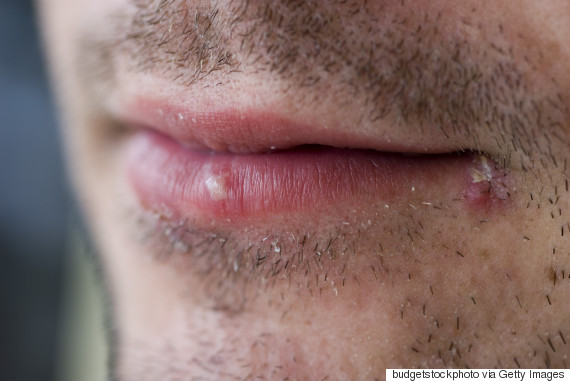 herpes virus lips
