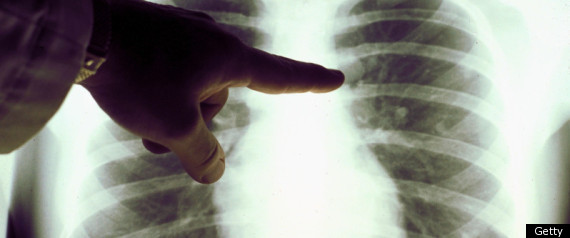 Screening Smokers