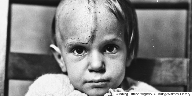 NSFW: The Faces Of America's Earliest Brain Surgery Patients