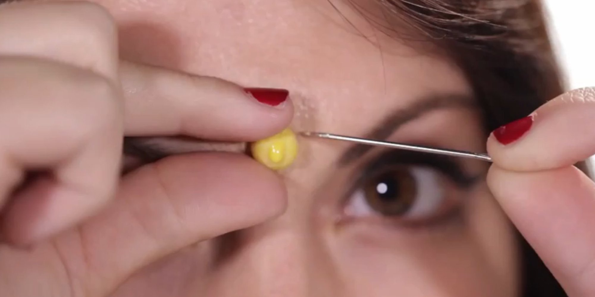 How To Pop A Big Pimple