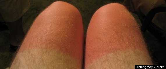 Sunburned Legs