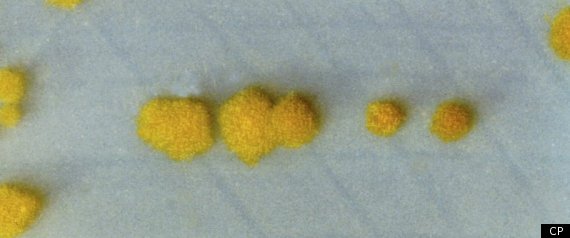 C Difficile