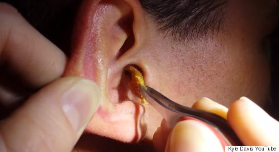 how-to-remove-impacted-earwax-specialists-remove-huge-piece-of-earwax