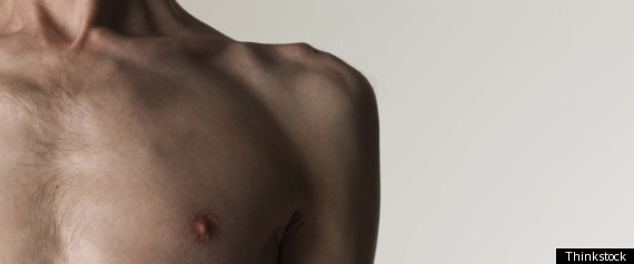 Eating Disorders Men