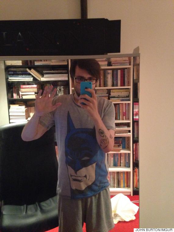 Excess Skin After Weight Loss Man Loses 260Ibs, Then Shares Brave