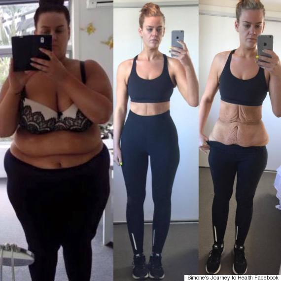 100 Lb Weight Loss Extra Skin Pictures