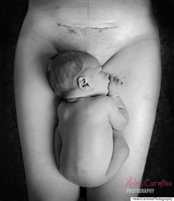 Scared About C-Sections? This Photo Has Started A Global Conversation About The Beauty Of A Mum's Body O-CSECTION-570