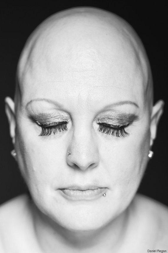 alopecia