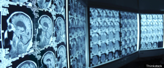 Diet Affects Brain