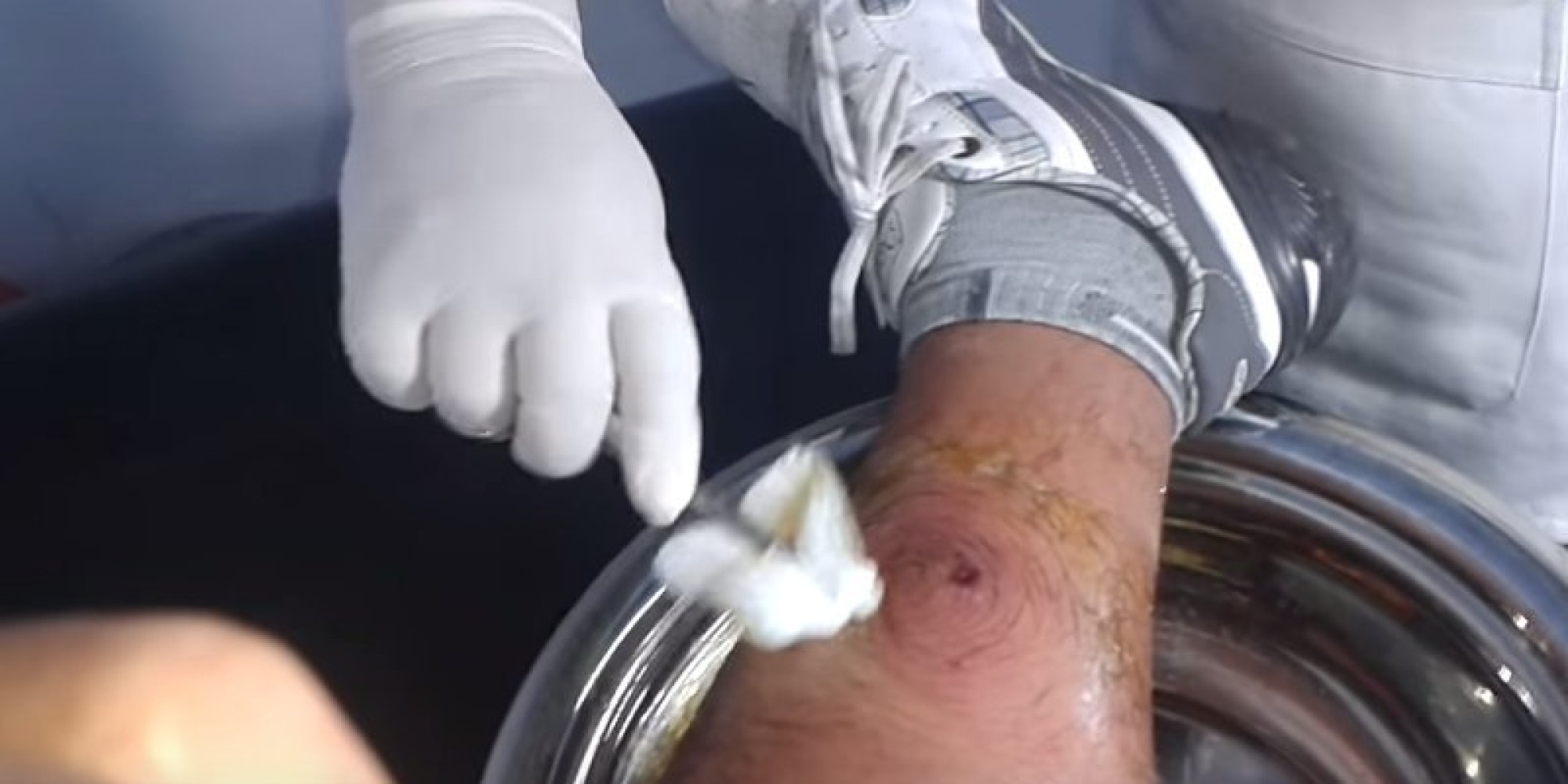 Warning: Video Of Man Having 3-Month-Old Cyst Removed From Leg Is