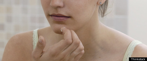 Acne Treatment