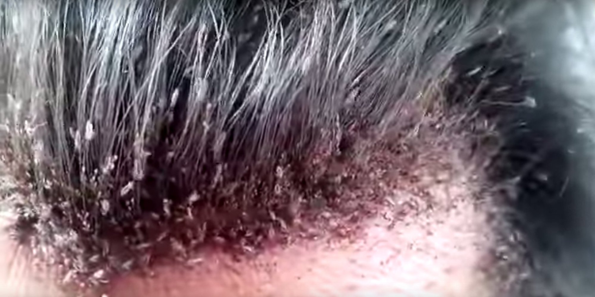Head Lice Infestation Video Is So Gross You Shouldnt Watch It 