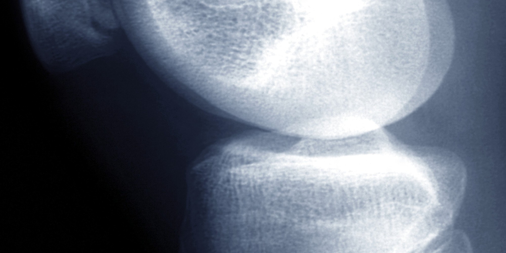 Hand Exercises Can Improve Grip Strength, Function, Pain and Fatigue in