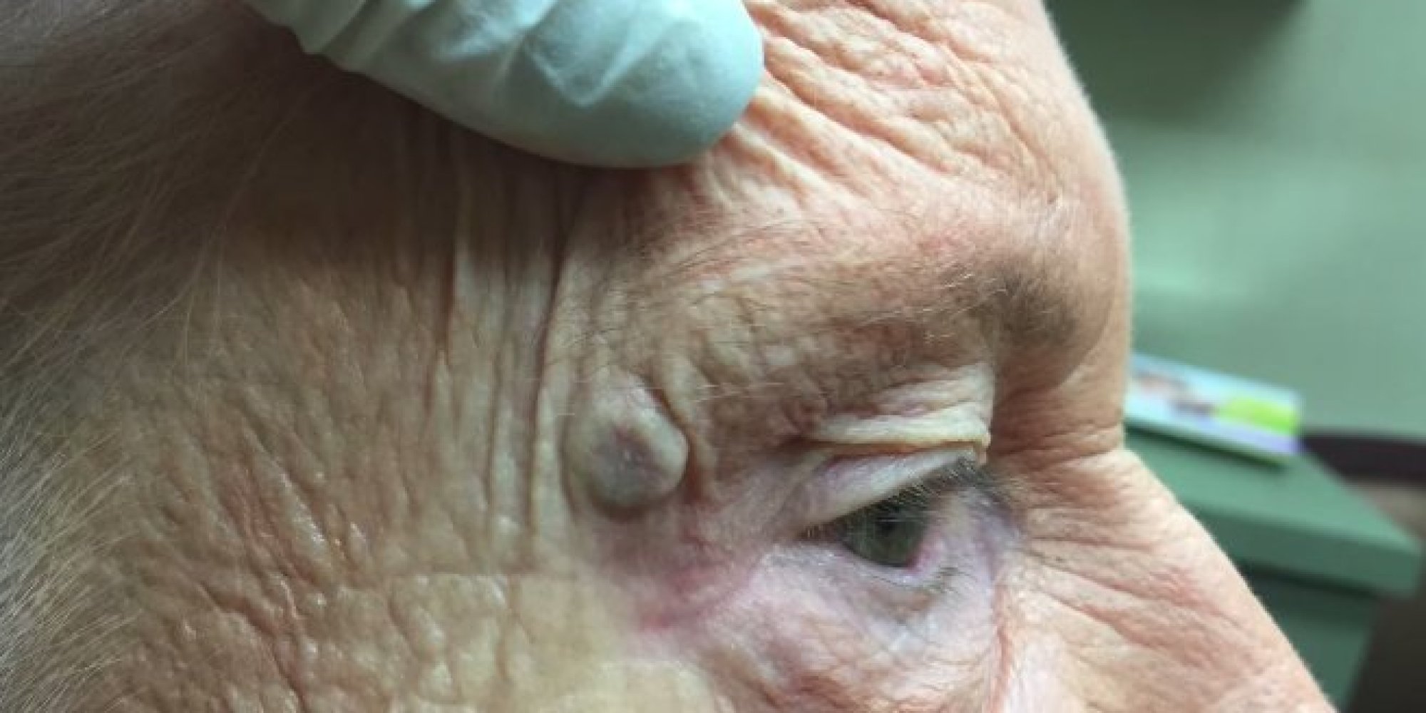 Dr Pimple Popper Tackles Massive Blackhead In Gross (Yet Oddly