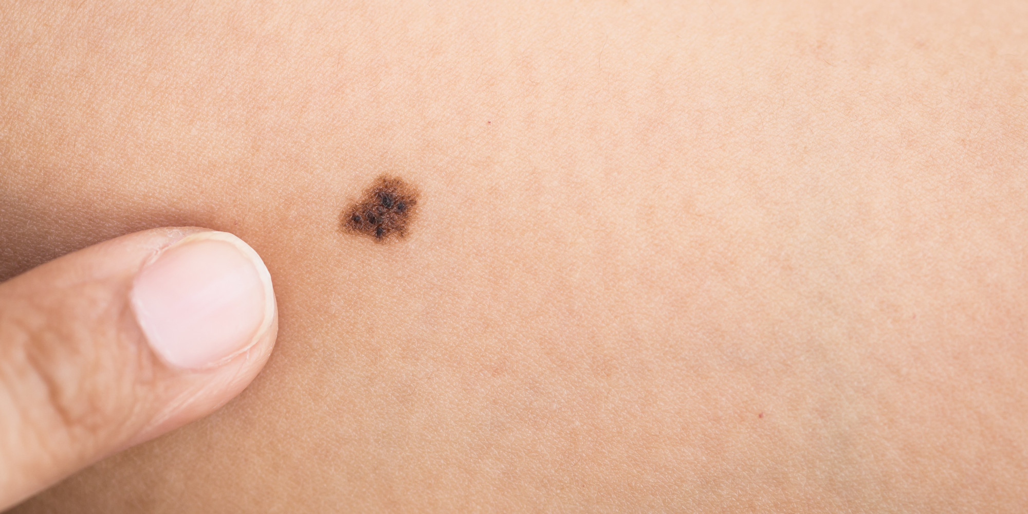 melanoma-and-the-importance-of-performing-skin-checks-huffpost