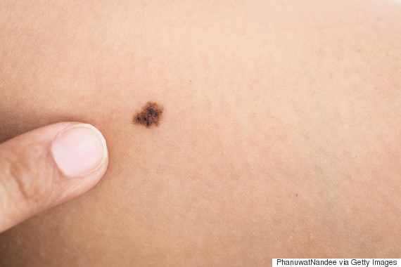 More Than 11 Moles On One Arm Could Indicate 'Higher Risk ...