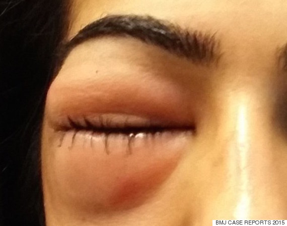 Woman Left With Severely Swollen Eye After Blowing Her Nose Too Hard