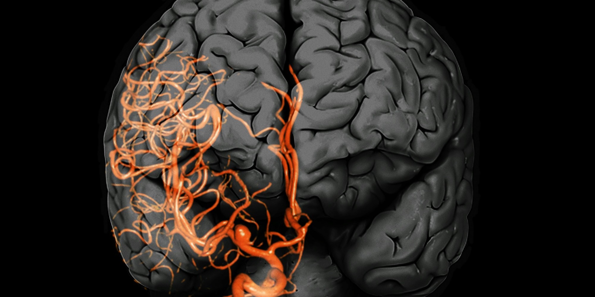 Can Brain Aneurysm Cause Blindness