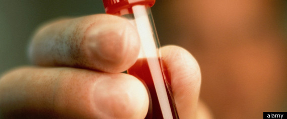 Prostate Cancer Screening