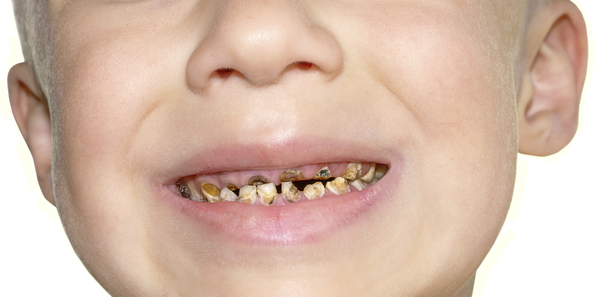 Dentists Say Sugar Free Drinks And Lollies Still Bad For Teeth