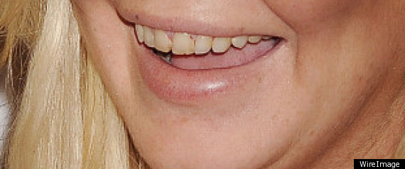 lindsay lohan teeth rotting