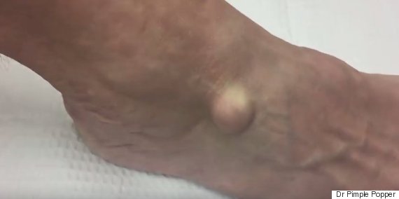 Cysts On Foot 32