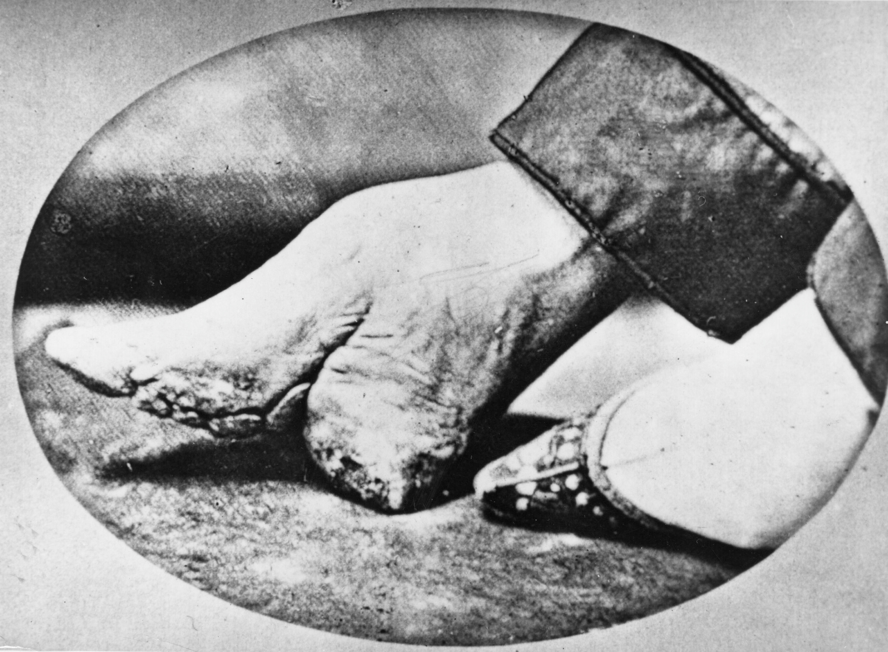 foot binding