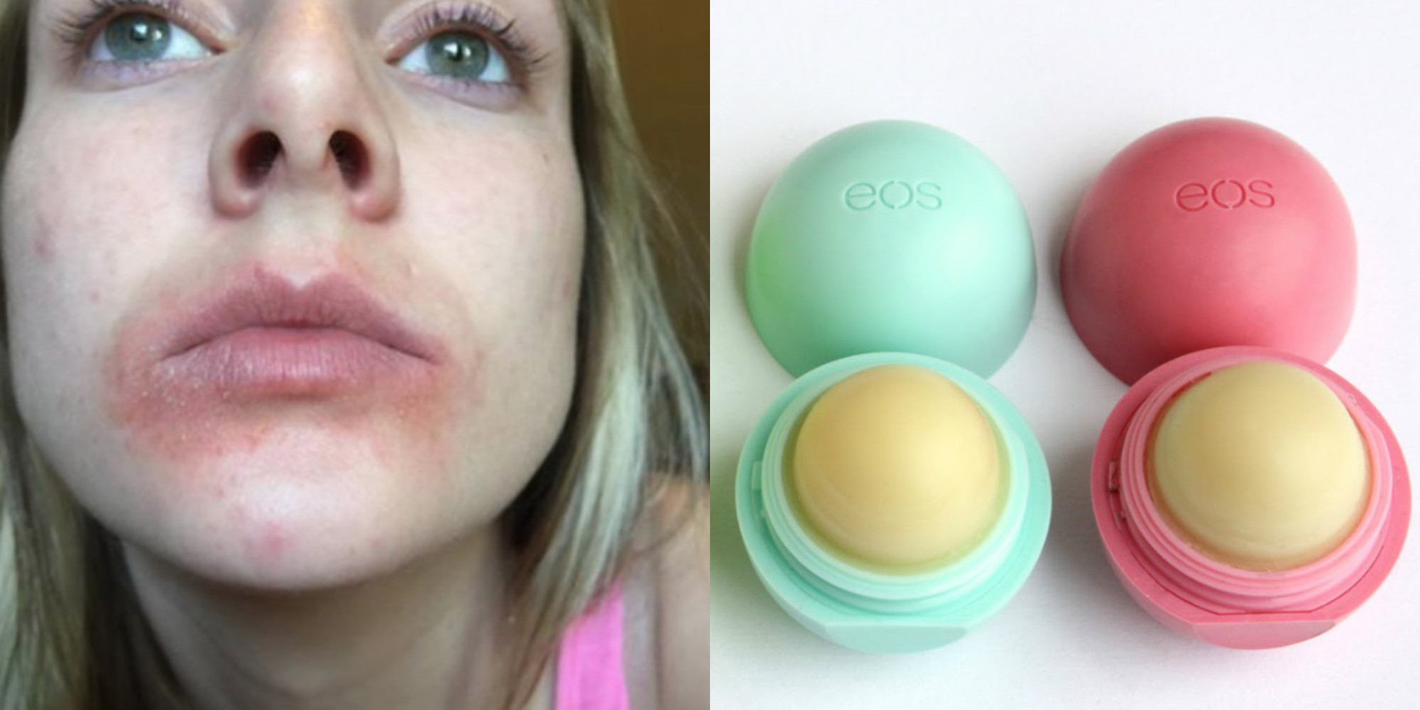 is-this-lip-balm-really-causing-rashes-what-to-know-about-the-lawsuit