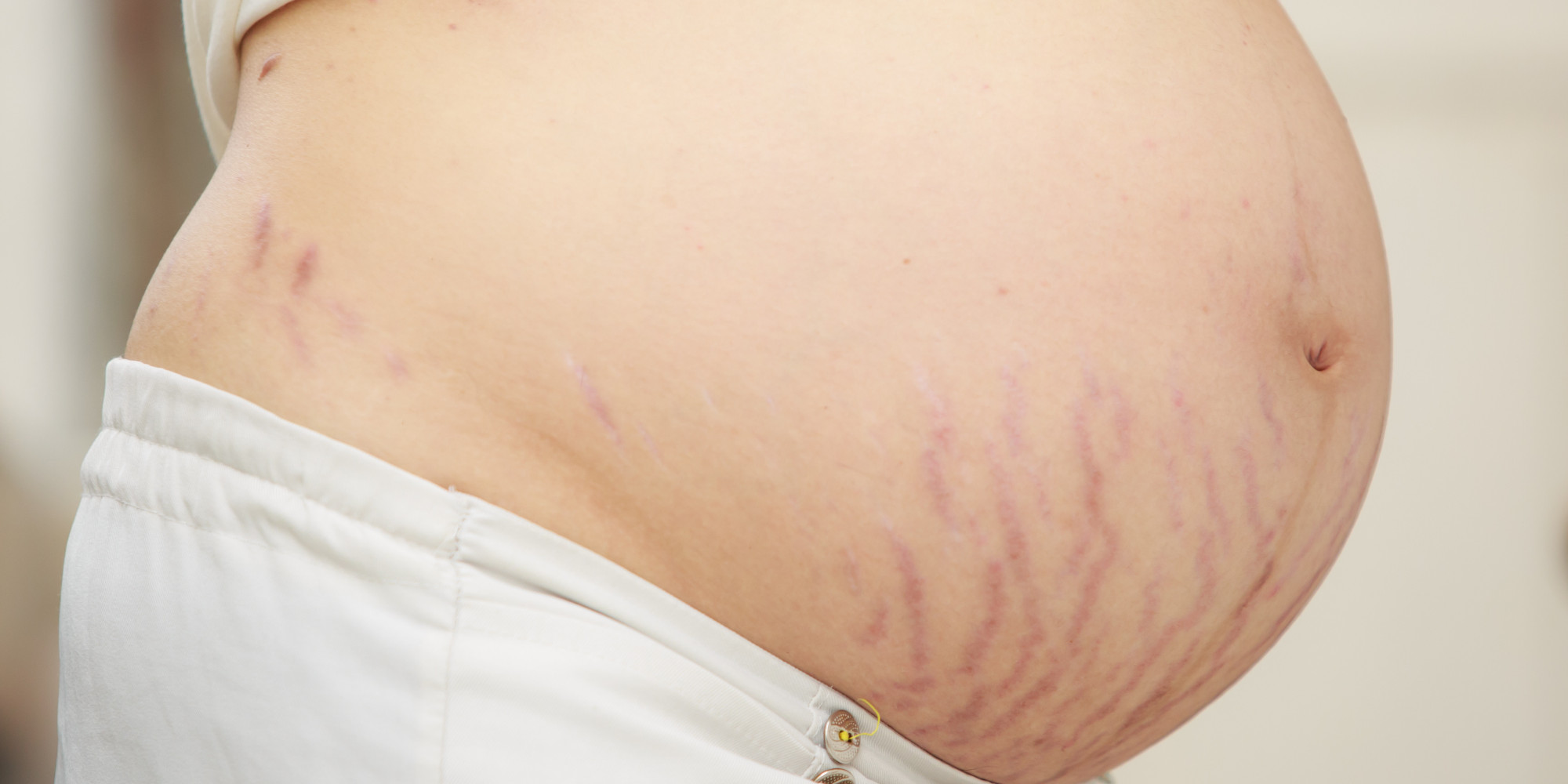 Dark Stretch Marks On Breasts During Pregnancy