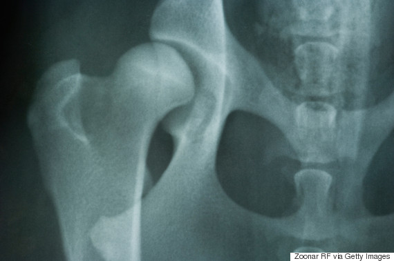 o-HIP-X-RAY-570.jpg