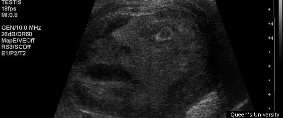 http://i.huffpost.com/gen/392610/thumbs/r-TUMOUR-FACE-TESTICULAR-CANCER-ULTRASOUND-large570.jpg