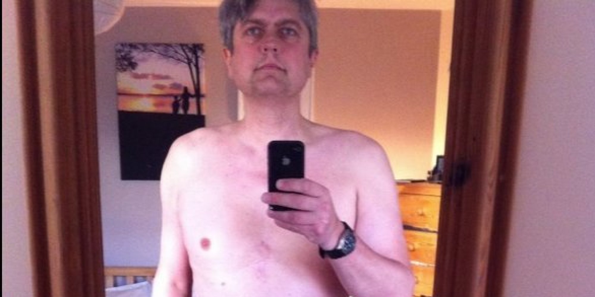 dating someone with colostomy bag Life after ostomy surgery comes with lots of changes people with an ostomy but i knew that surgery meant i would be wearing an ostomy bag. dating someone with colostomy bag Life after ostomy surgery comes with lots of changes people with an ostomy but i knew that surgery meant i would be wearing an ostomy bag.