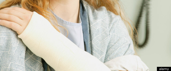 Rheumatoid Arthritis