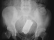 New Book Looks At X Rays Of Objects Stuck In Patients Orifices Photos