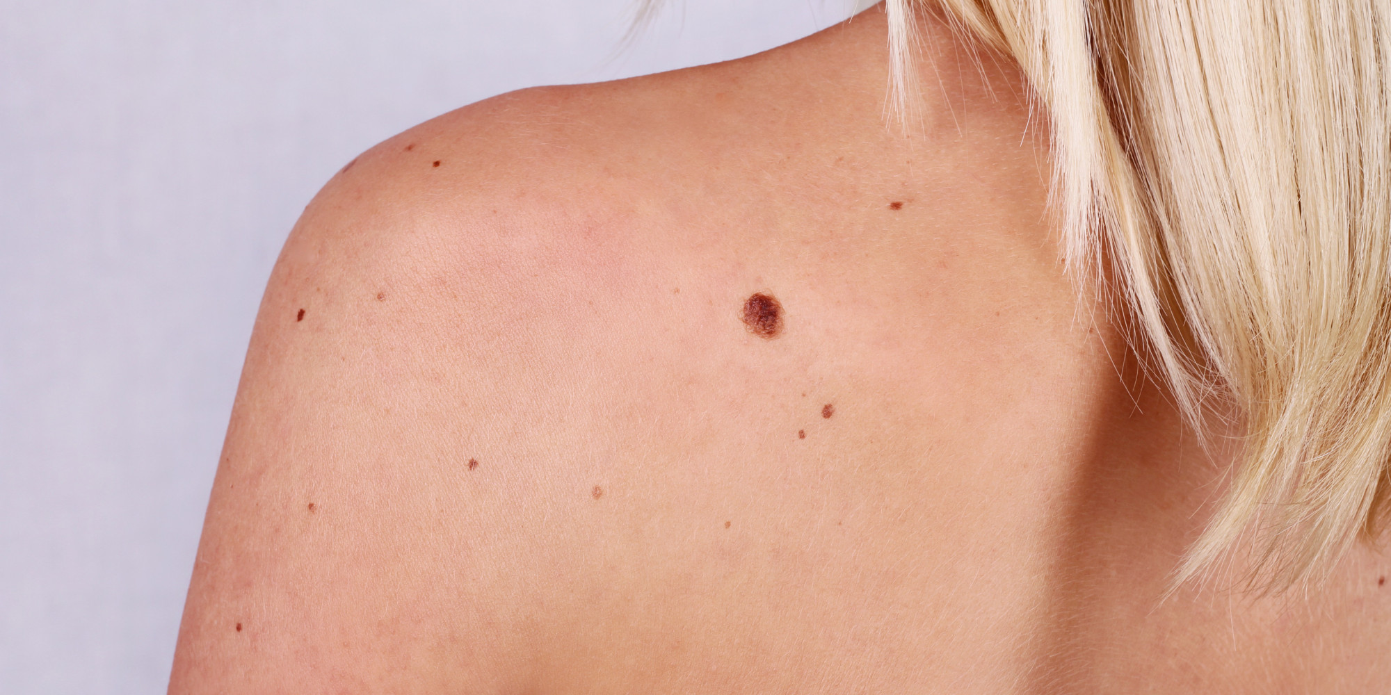 What A Skin Cancer Mole Looks Like