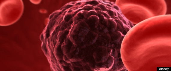 Cancer 10 Years Ahead Of Treatment
