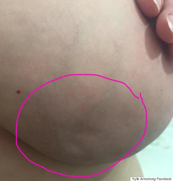 skin cancer on breasts #10