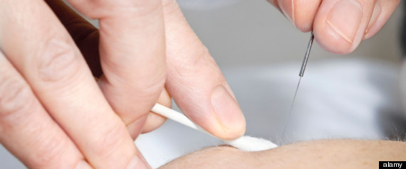 Acupuncture Children