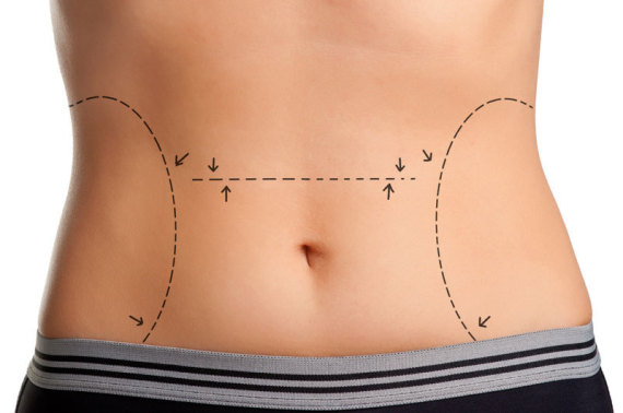 tummy tuck