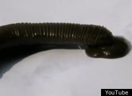 WATCH: Doctors Remove 4-Inch Leech From Teenage Boy's Throat