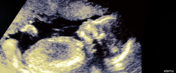Wrong Twin Foetus Aborted In Australia