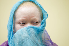 Kind mit Albinismus | Bild: PA